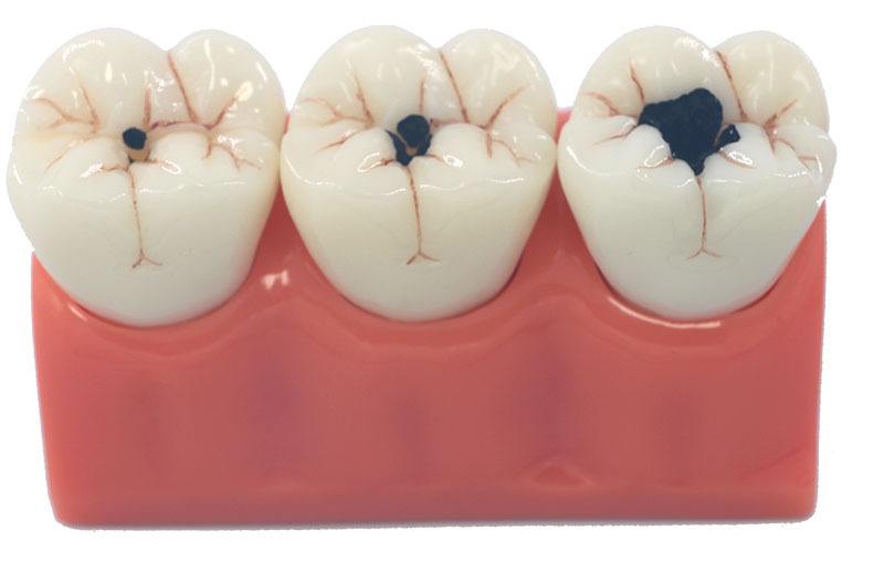 牙齿龋坏究竟要怎么办，补牙之后又能用多久呢？听听看牙医怎么说