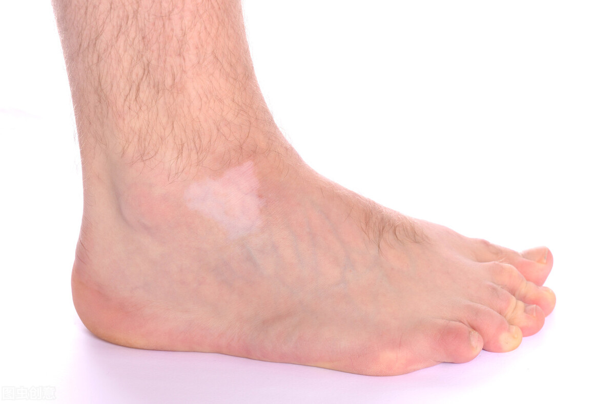 如何正确治疗患上白癜风?