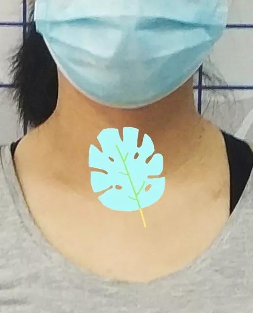 咽喉炎梅核气如何治疗,慢性咽炎梅核气怎么治疗