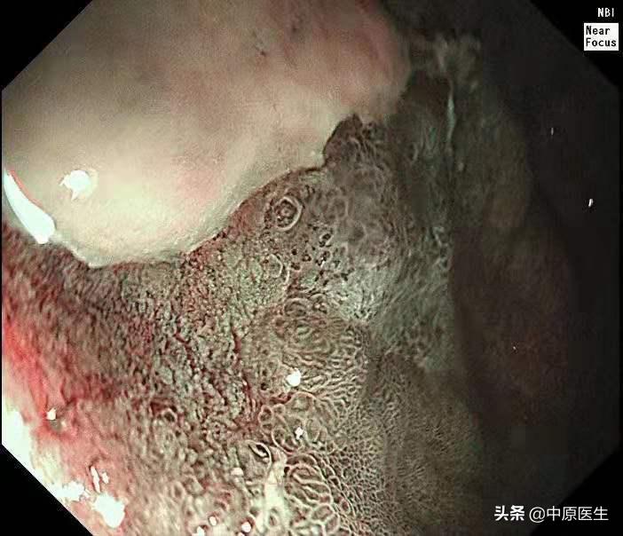必须活检的胃溃疡:以为是胃溃疡,专家用另一方法放大发现是胃癌