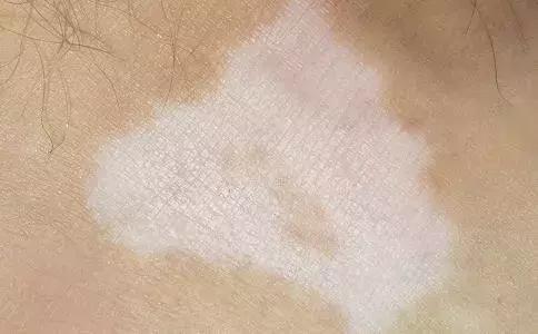 白癜风和牛皮癣哪个更难治疗好 (牛皮癣和白癜风同时得如何治)