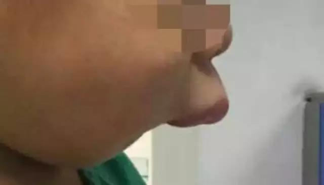 上牙龈上火突出一个鼓包,牙龈肿胀鼓包上火了吗