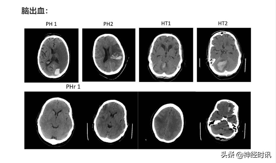 急性脑梗死取栓术的护理,脑梗死溶栓取栓围手术期护理常规