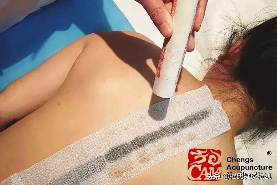 关于艾灸的那些事,答疑解惑揭秘