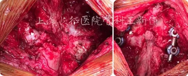 颈椎外伤受损如何治疗,颈椎损伤手术恢复怎么样