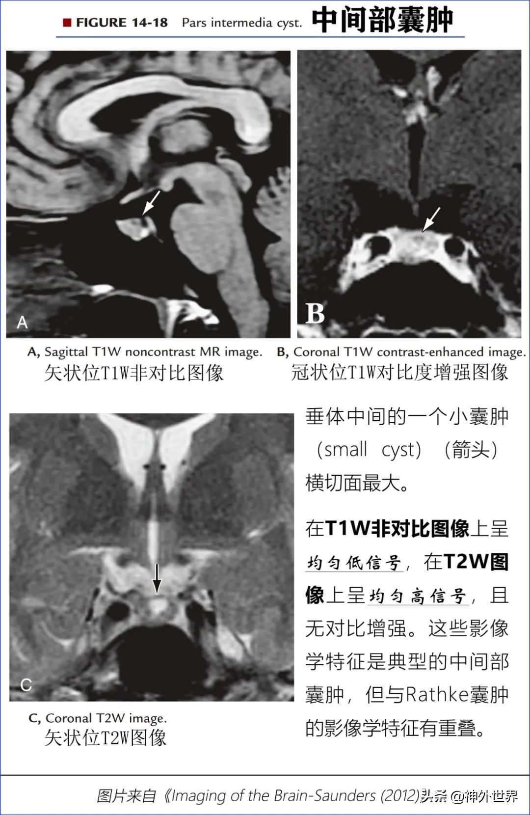 鞍区解剖学习笔记之——垂体