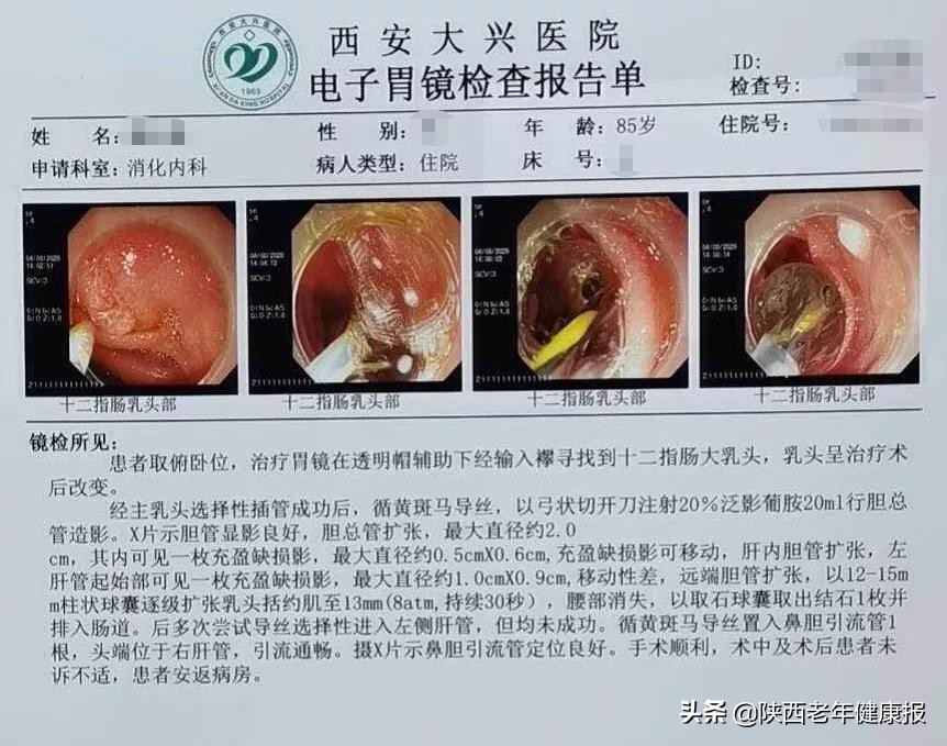 内镜微创取石手术,微创取石最新视频