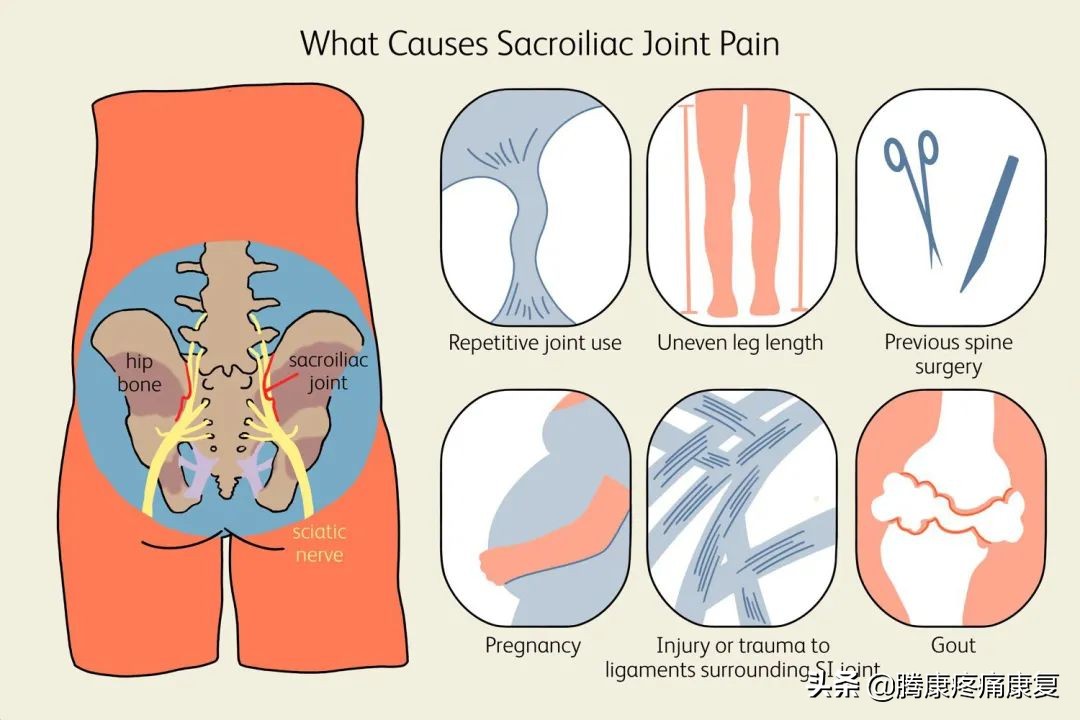 骶髂关节疼痛的原因一般是什么,骶髂关节夜间疼痛口服什么药品