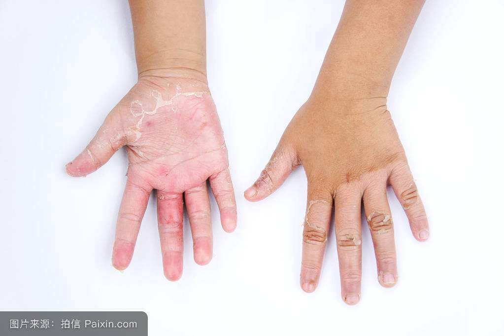 手指每年春天就起泡脱皮怎么治疗,宝宝手指起泡后反复脱皮