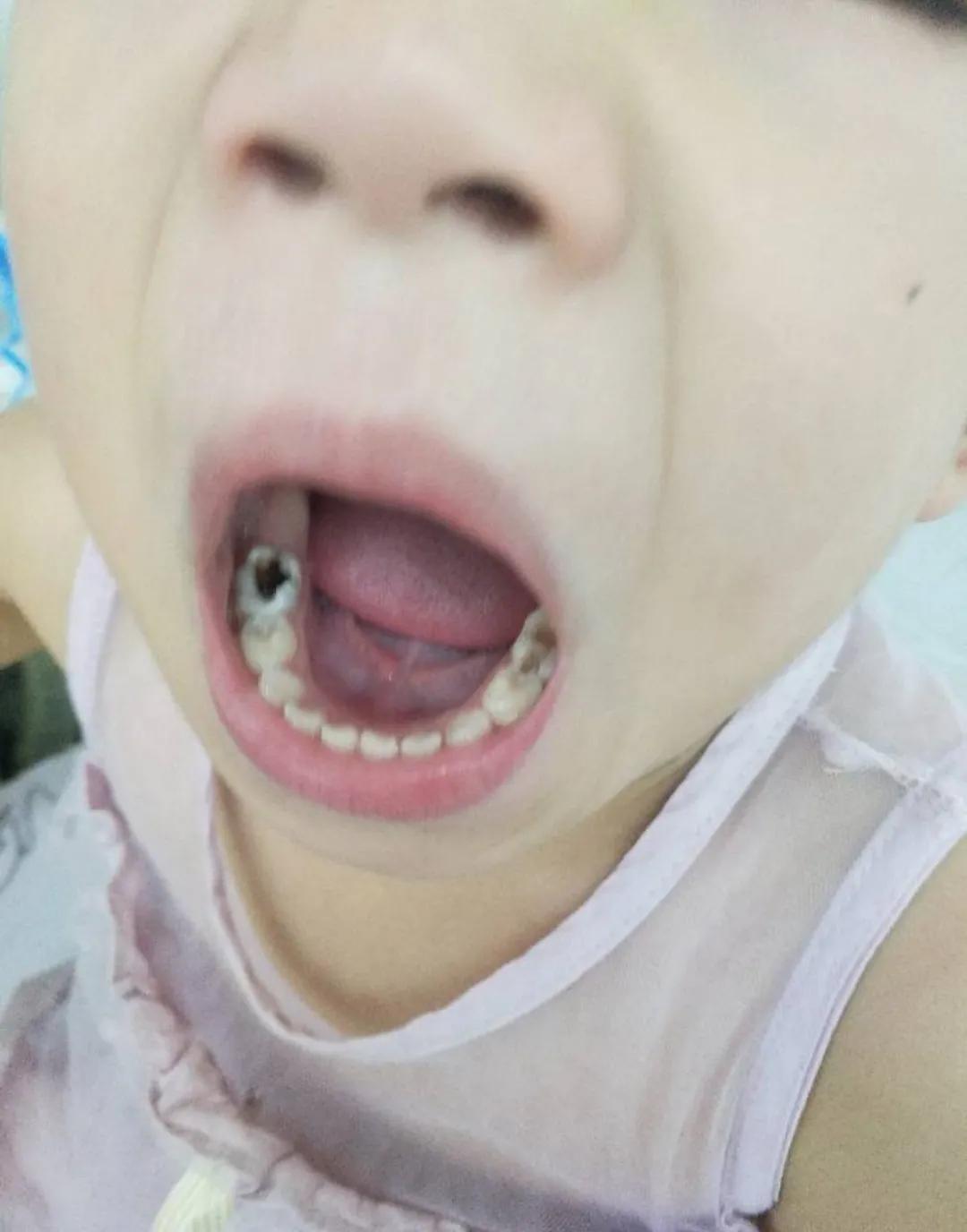 宝宝才三岁牙都坏了咋办,宝宝快三岁了牙齿才16颗