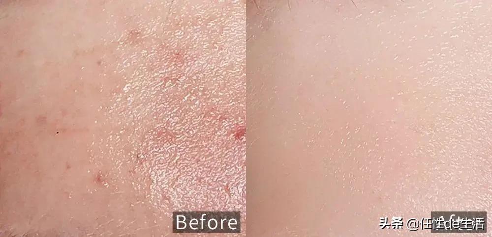刷酸为什么避开脸颊,刷酸会脸垮吗
