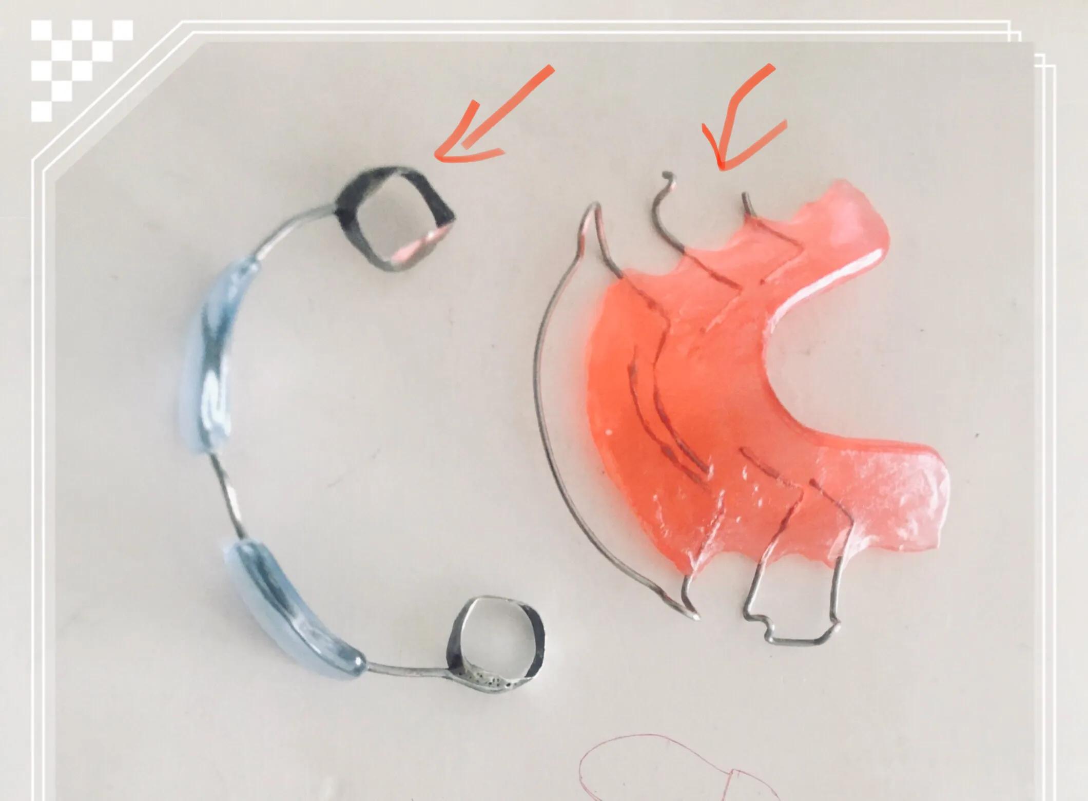 孩子咬下嘴唇龅牙需要多少钱,小孩咬下嘴唇龅牙