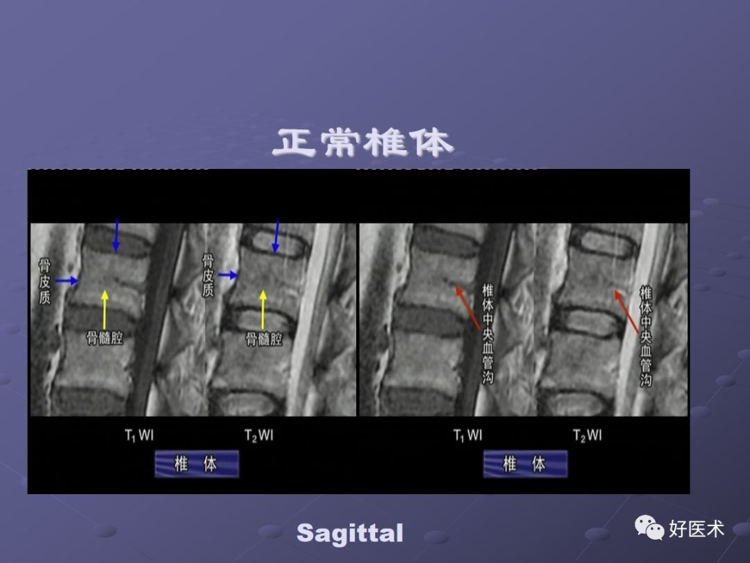 脊柱mri有哪些特点,乳腺疾病的mri诊断及鉴别