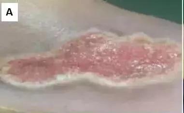 造血干细胞重获新生,神奇的干细胞让他们重获新生