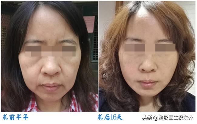 拉皮手术后的真实面部整形失败,脸部整形美容后遗症