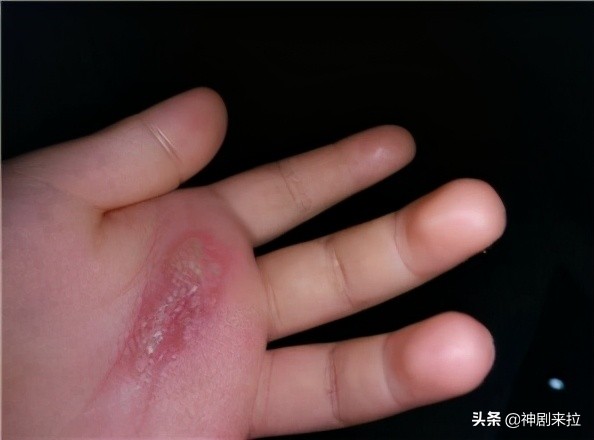 煤炭二三事｜大学生被烫掉一层皮