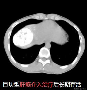 介入疗法的未来前景,介入治疗快速发展