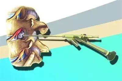 腰突脊柱侧弯最好的恢复方法,腰突为什么会引起侧弯