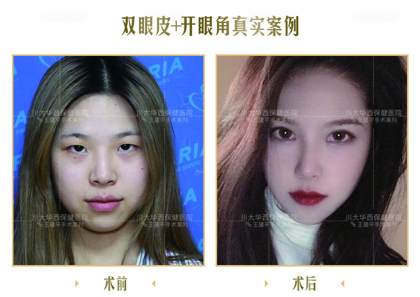 双眼皮有几种类型适合哪些脸型,各种类型的双眼皮适合啥样的人做