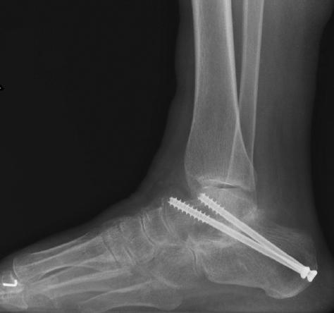 昨天介绍了踝关节创伤性关节炎，今天来聊一聊距下关节炎的诊治