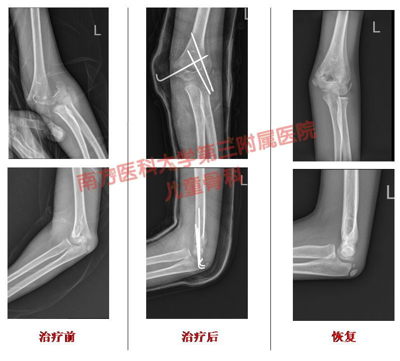 胳膊骨折三个月腿又骨折,孩子胳膊骨折好后还容易骨折么