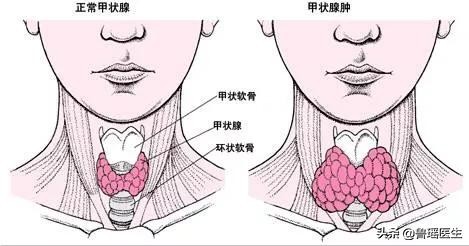 非毒性结节性甲状腺肿啥意思,结节性甲状腺肿2级什么意思