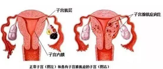 子宫腺肌症做手术能彻底好吗,子宫腺肌症挖除病灶手术注意事项
