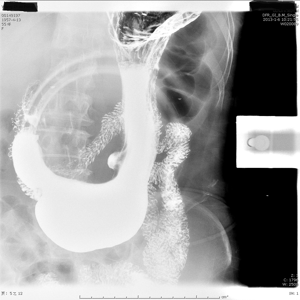 胃镜无法通过是什么原因,胃镜可以替代喉镜检查吗