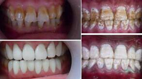 大连齿医生口腔科普5种常见行为习惯,让你牙龈越来越脆弱