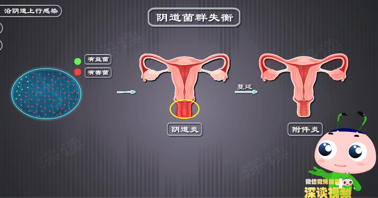 妇科附件炎最佳治疗方法,人流后附件炎是怎么引起的