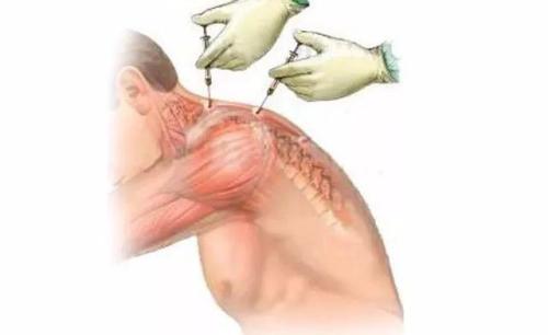 硬肩耸肩怎么办,肩膀僵硬怎么合理开肩