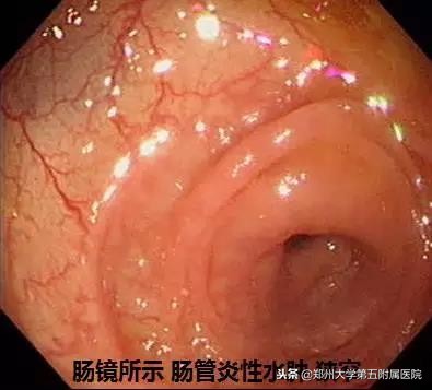 十来年肠绞痛的表现和处理方法,十年腹痛