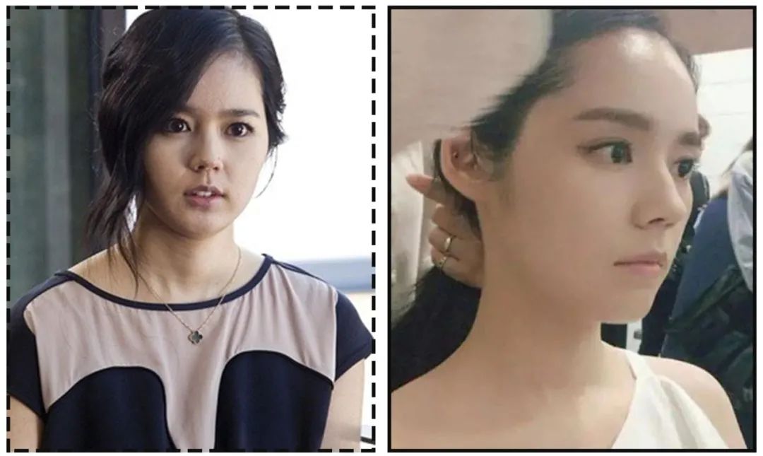 娄艺潇填充脂肪前后对比,娄艺潇填充前后对比