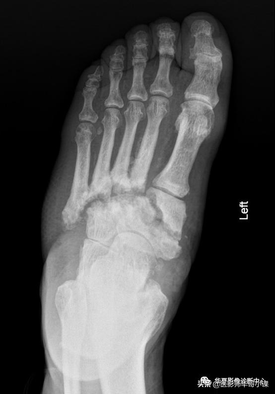 神经性脊椎炎,神经性风湿病