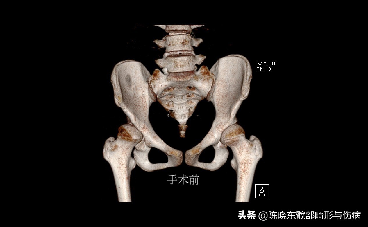 髋关节发育不良发病,髋关节发育不良的原因和治疗方法