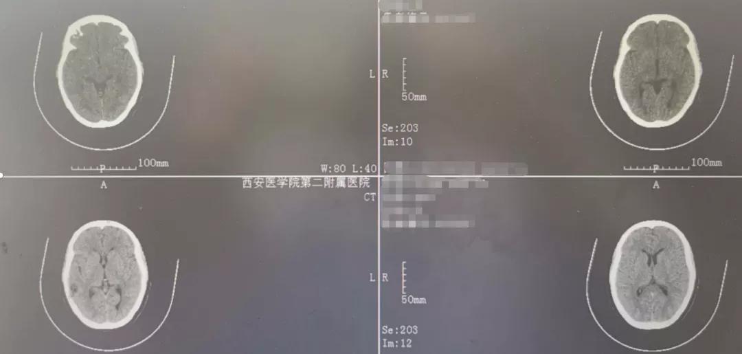 突然头疼要炸了怎么回事,睡觉突然头疼剧烈要炸了