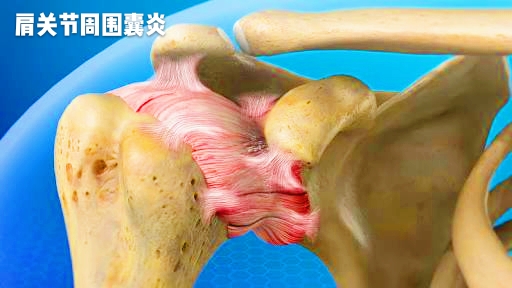 肩部突然酸痛睡不着觉,肩部肌肉疼痛到睡不着