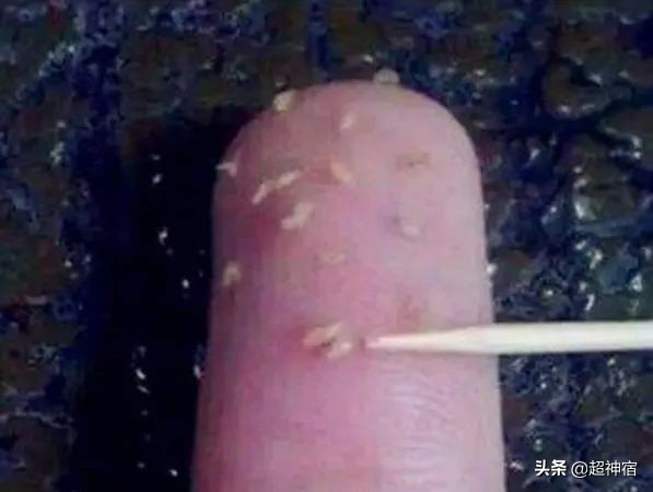 教你5个根治闭口粉刺方法,闭口痘痘彻底根治