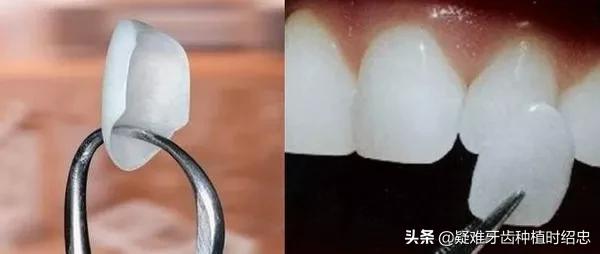 改变刷牙方式楔状缺损就会停止吗,刷牙导致楔状缺损牙齿会断么