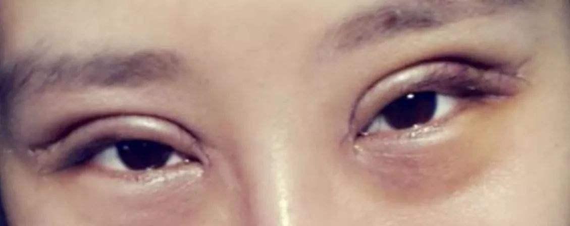 割双眼皮的危害和后遗症,割双眼皮失败还能补救吗