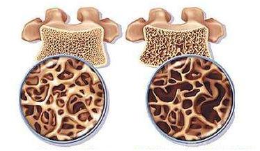 血钙含量和骨质疏松有关吗?