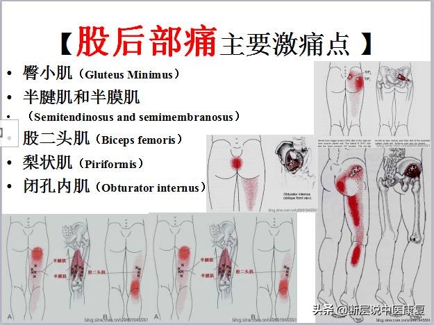 激痛点挂图,激痛点疗法笔记
