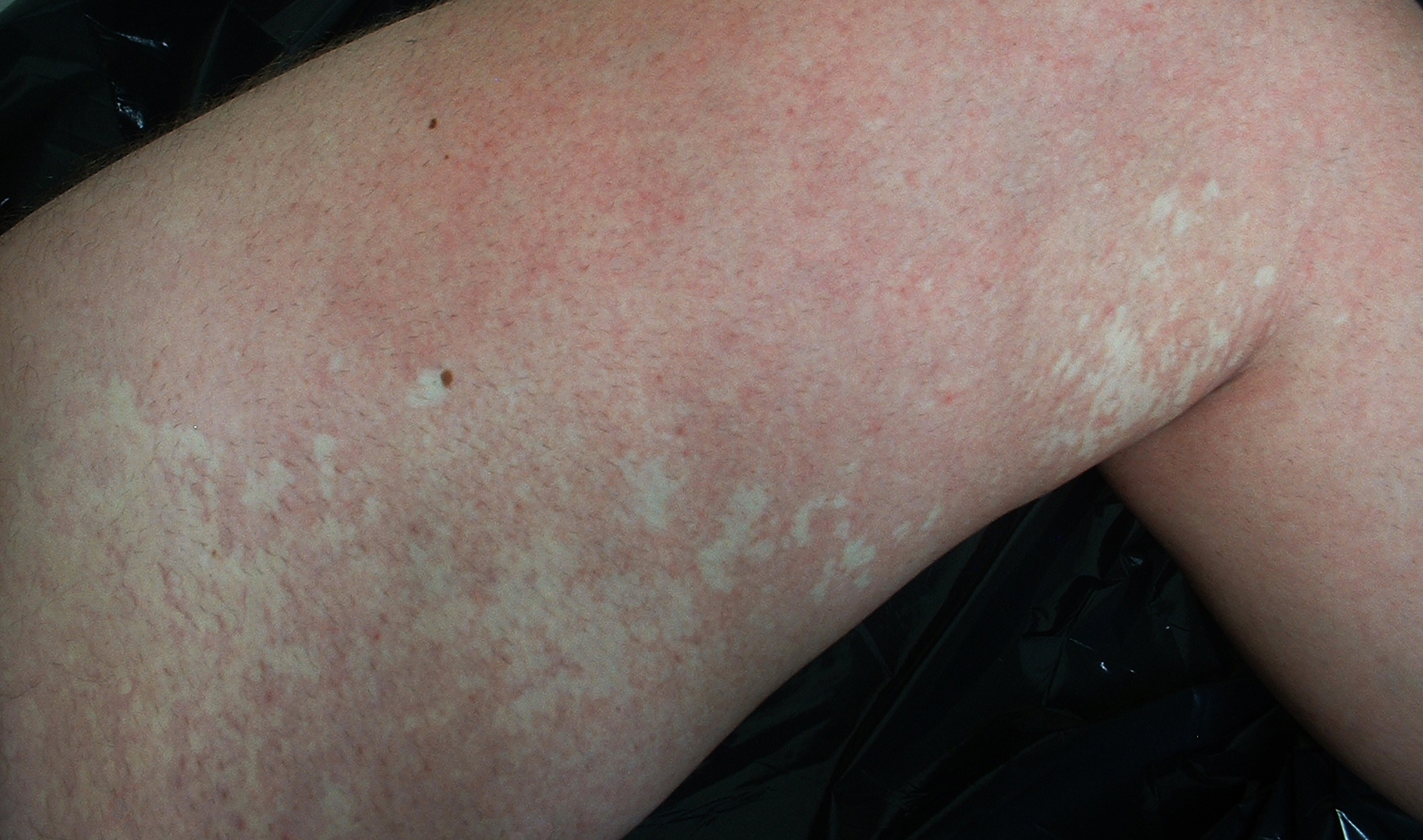 白斑是白癜风吗医生为你详解,得了白癜风感觉身上都是白斑