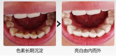 洗牙遭罪不,洗牙难受怎么办