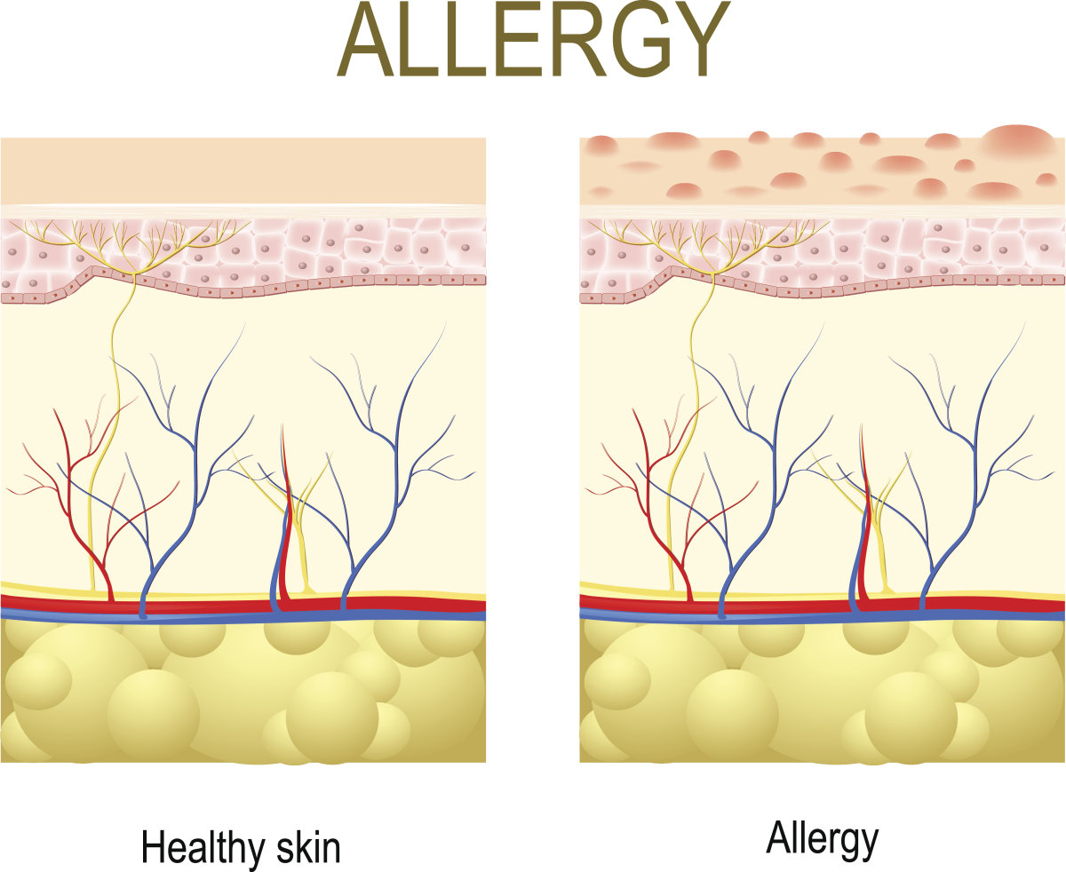 轻微皮疹怎么治疗,药物过敏皮疹腹泻多久能好