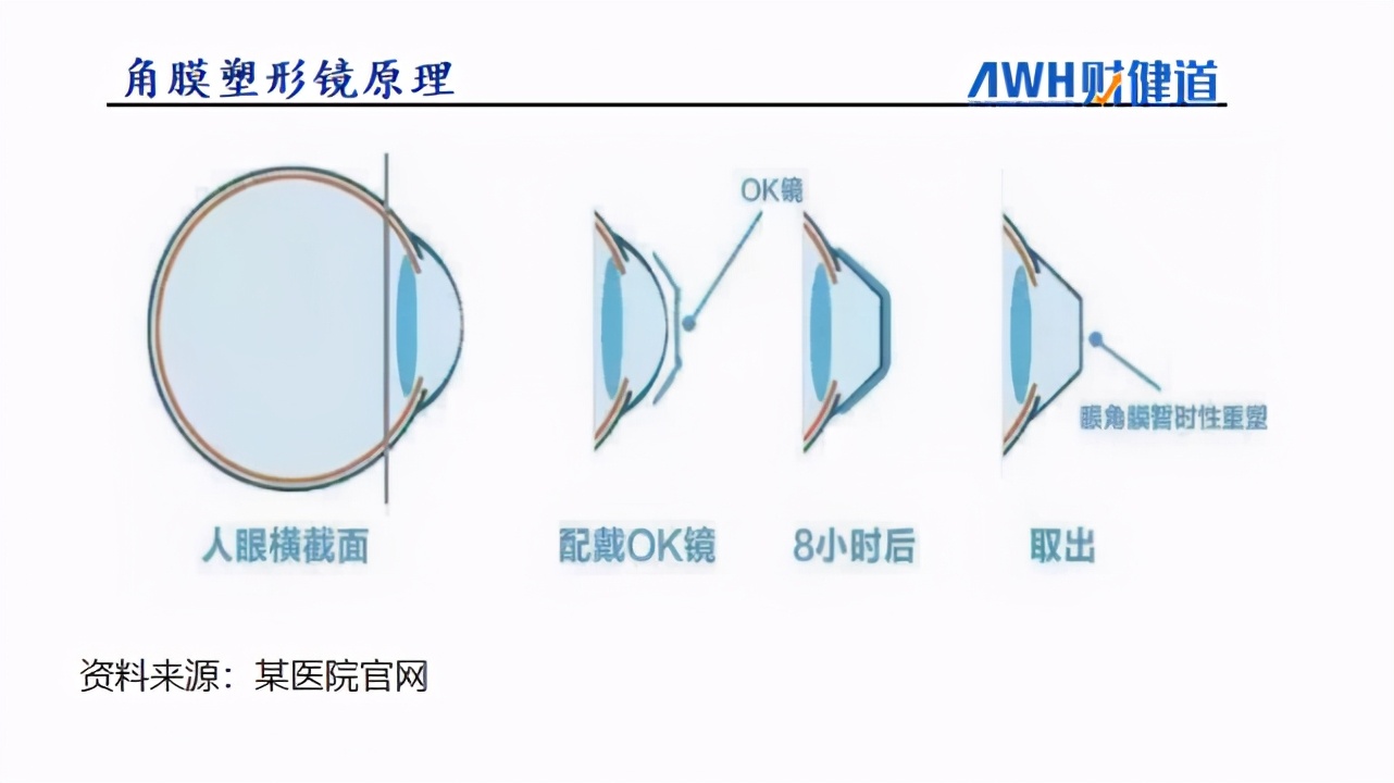 上亿孩子近视！OK镜成三高生意，焦虑家长撑得起“眼茅”近千亿市值吗？