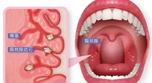 种草鸡丨惊呆了！30秒漱出扁桃体结石！