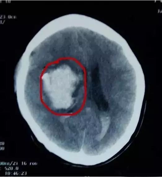 1岁女孩摔下意外死亡,1岁女婴从3楼摔落生命垂危