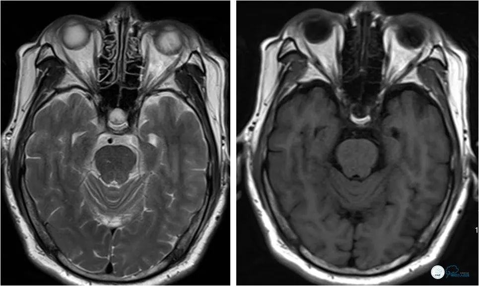 椎动脉狭窄介入手术病例汇报,基底动脉狭窄70%的介入治疗