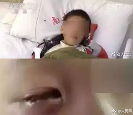 20分钟孩子眼球被干燥剂融化,20分钟孩子的眼睛被融化